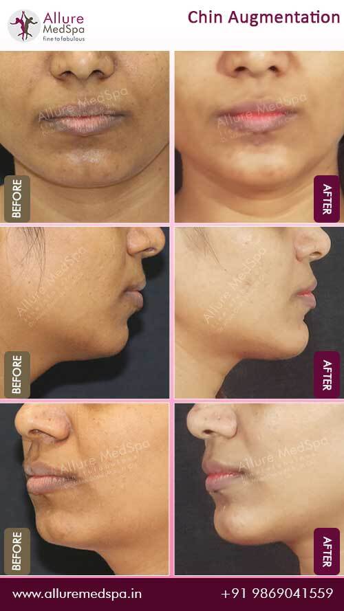 Chin Augmentation Patient Before and After Pictures at Allure MedSpa in Mumbai, India - Dr. Milan Doshi