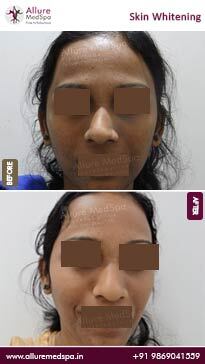 Before and after results of successful skin whitening treatment at cosmetic surgery clinic in mumbai
