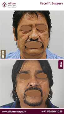 facelift before and after young