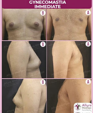 GYNAECOMASTIA GRADE 3 SURGERY IMMEDIATE BEFORE AND AFTER