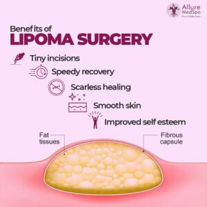 Lipoma Surgery benefits: small incisions, smooth skin, scarless healing and more confident