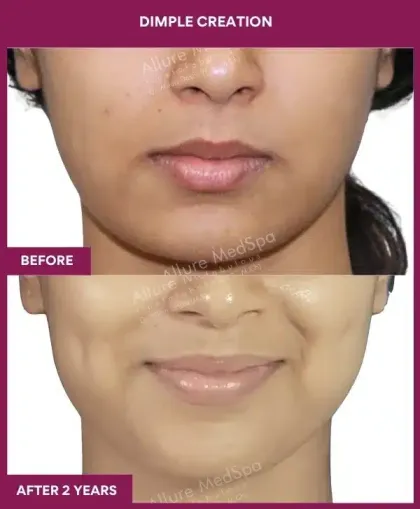 Dimple Creation Before After Image in Mumbai, India