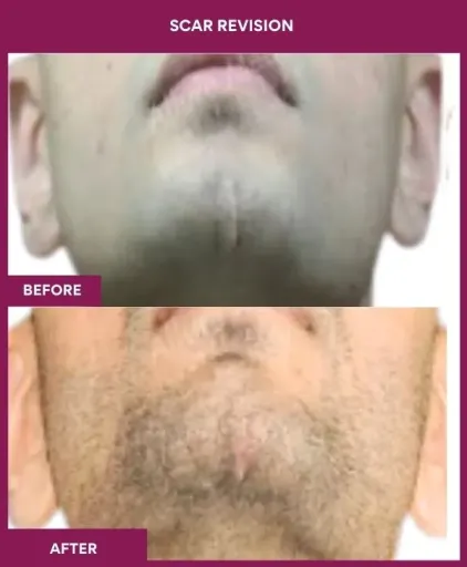 10 Scar Revision (2)_17_