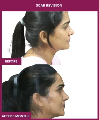 9 Scar Revision (2)_14_