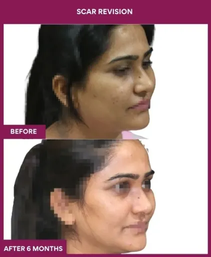 9 Scar Revision (3)_14_