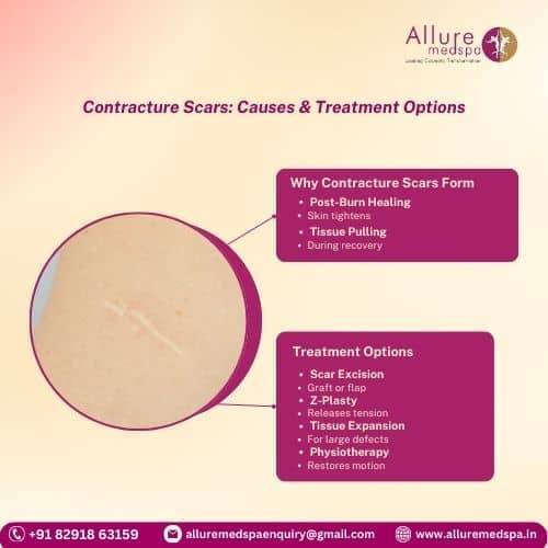 Contracture Scars_ Causes & Treatment Options in Mumbai, India