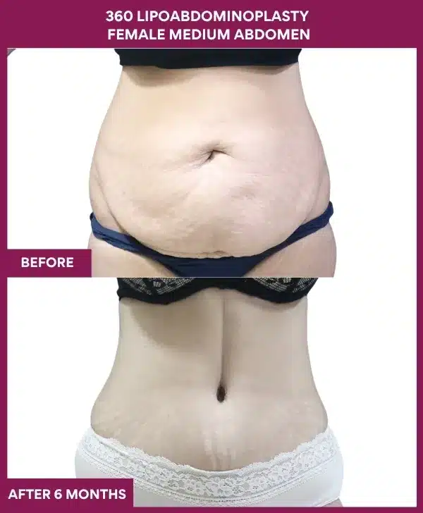360 lipoadominoplasty Before After Image in mumbai, India