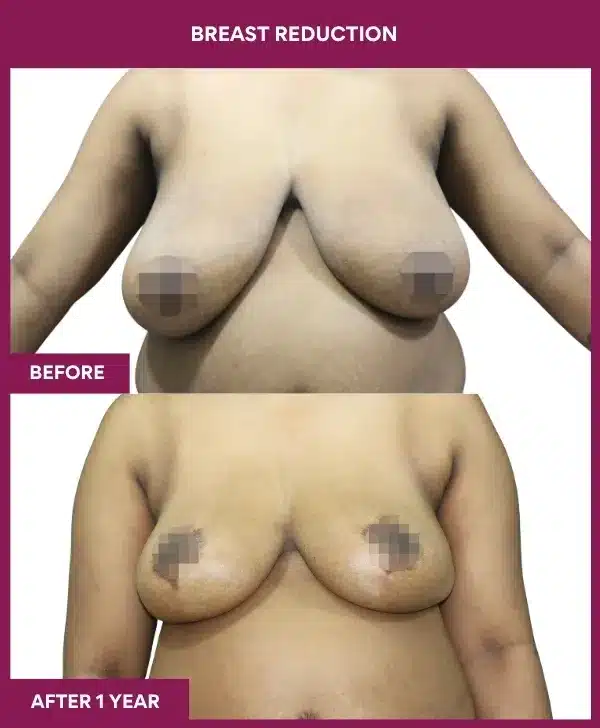 Breast Reduction Before After Image in mumbai, india