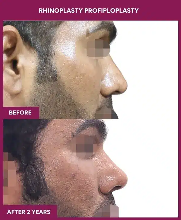 Rhinoplasty Surgery before after image in mumbai, india