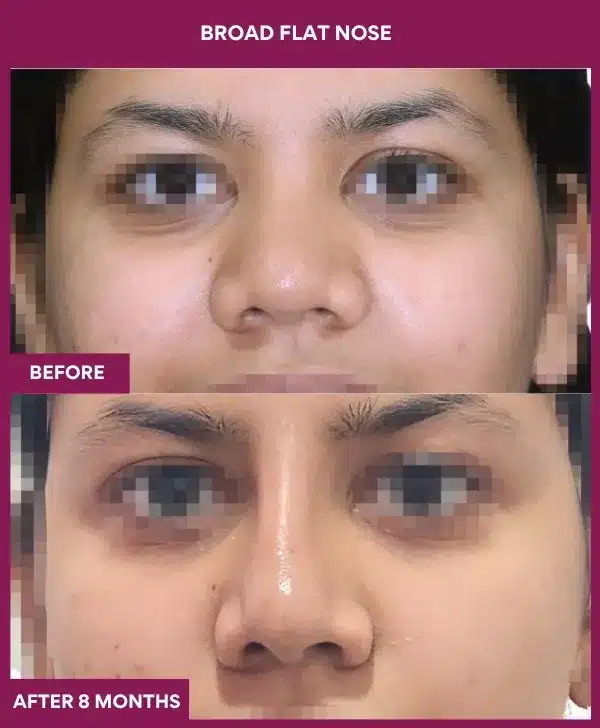 Broad Flat Nose Before After Result