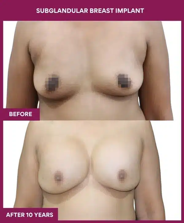 Breast Implant Before After Image in Mumbai, India