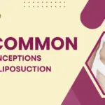10 Common Misconceptions About Liposuction