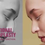 Functional rhinoplasty