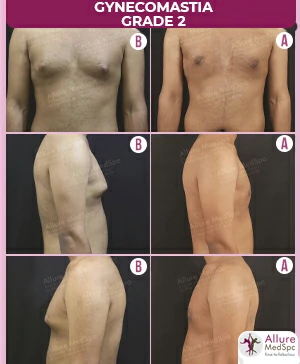 GYNAECOMASTIA-GRADE-2.-MALE-BREAST-REDUCTION-SURGERY-RESULT-AND-COST-2 (1)