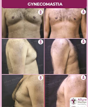 GYNAECOMASTIA-GRADE-3-SURGERY-SKIN-TIGHT-RESULT-COST-IN-ANDHERI-WESTMUMBAI-INDIAGynecomastia