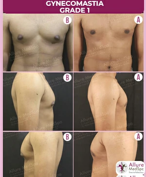 GYNAECOMASTIA-SURGERY-1-.MALE-BREAST-REDUCTION-SURGERY-RESULT-AND-COST (1)