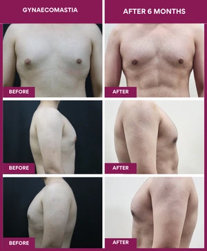 Gynecomastia-Surgery-Result-after-6-month (1)