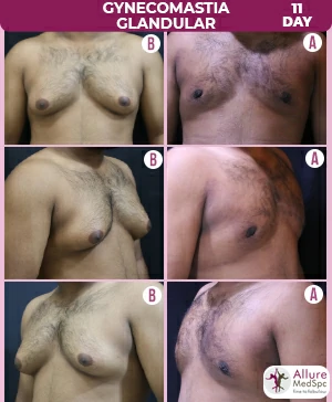 Gynecomastia_Glandular
