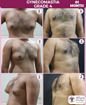 Gynecomastia_Grade4