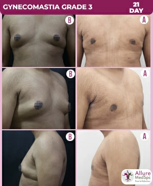 Gynecomastia_grade_3