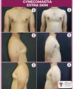 LARGE-GYNAECOMASTIA-WITH-EXTREA-SKIN-SCARLESS-MALE-BREAST-REDUCTION-SURGERY-RESULT-COST