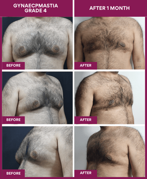 Male-Breast-Reduction-Surgery-Result-Mumbai-India (1)