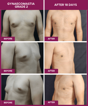 Male-Breast-Reduction-Surgery-Result-before-after-image (1)