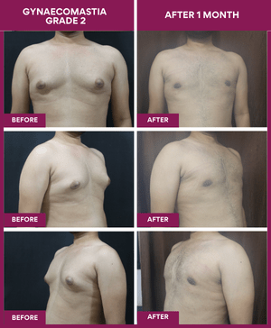 Male-Breast-Reduction-Surgery-Result-image (1)