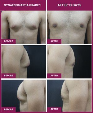 13 days post gynecomastia grade 1 surgery result: 27 y male/ Gym trainer/ was not able to get read of male breast even after chest muscle build up carrier