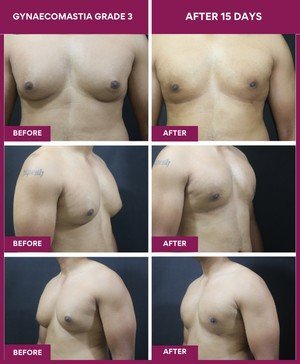 15 days post gynecomastia grade 3 surgery result: 29 y male/ Finance professional/ was feeling shy in meetings