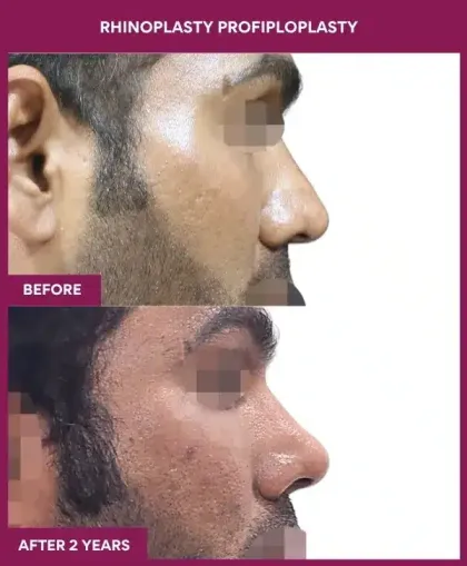 Rhinoplasty Surgery before after image in mumbai, india