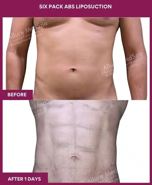 1- Six Pack Abs Liposuction-- (2)