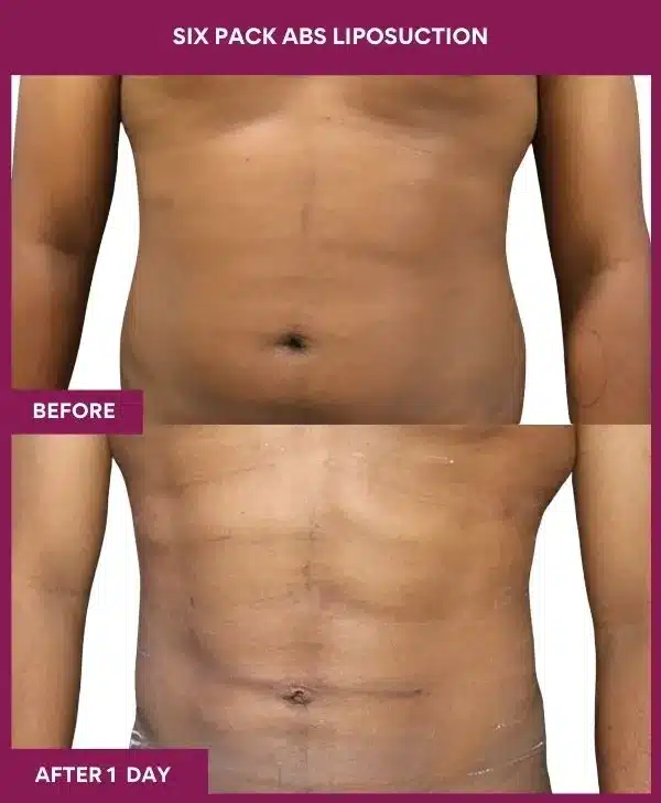 7 Six Pack Abs Liposuction (7)_67