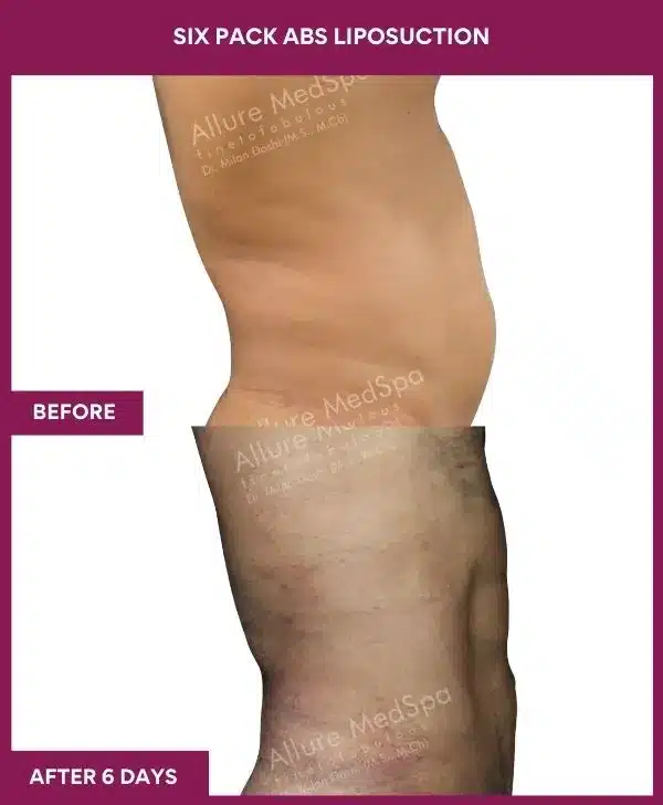 8 Six Pack Abs Liposuction (5)_64