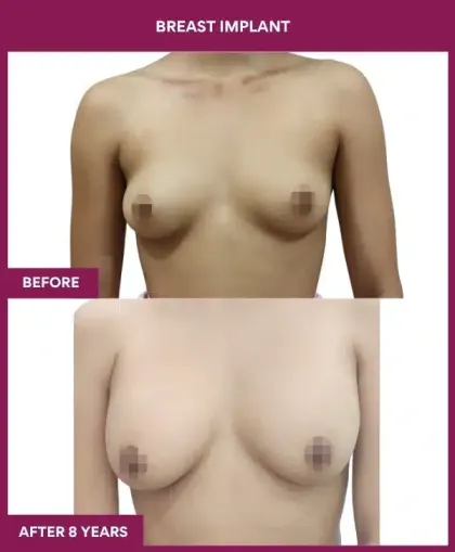 Breast Implant Before After Image in mumbai, india