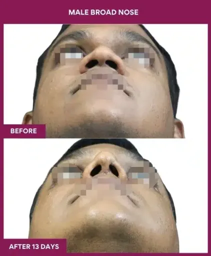 1 male broad nose in Mumbai, India