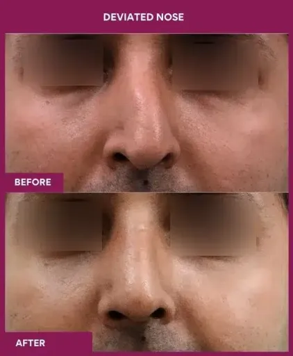 11 deviated nose_37 in Mumbai, India