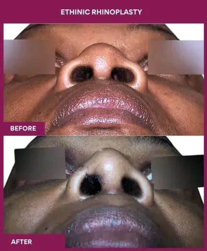 12 ETHINIC RHINOPLASTY in Mumbai, India