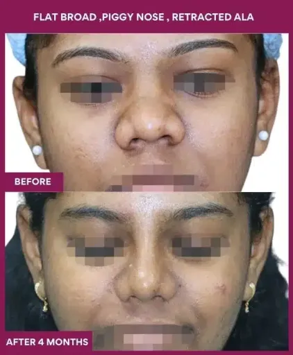 14 FLAT BROAD ,PIGGY NOSE , RETRACTED ALA_46_ (1)