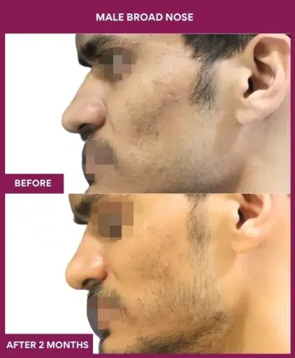 2 male broad nose in Mumbai, India