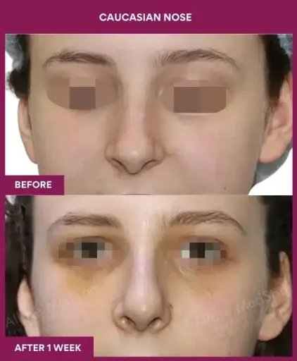 7 Caucasian nose_25 in Mumbai, India