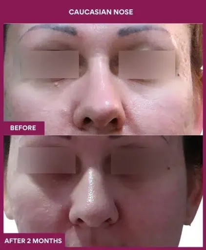 8 Caucasian nose in Mumbai, India