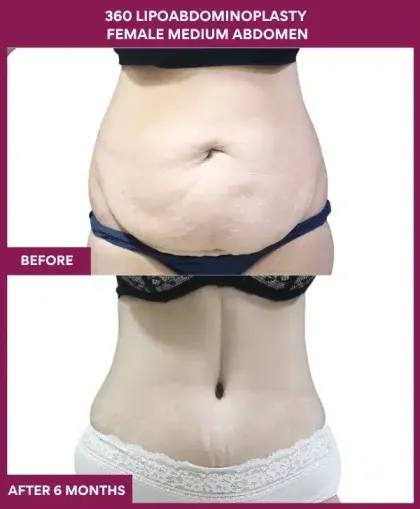 360 lipoadominoplasty Before After Image in mumbai, India
