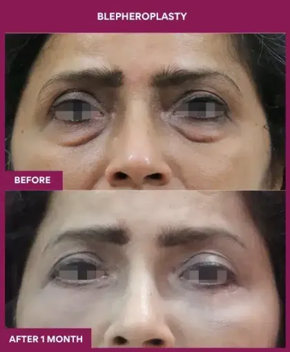Blepheroplasty/ Eyelid Surgery Before After image in mumbai, india