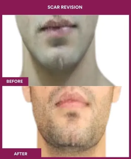 10 Scar Revision (3)_17_