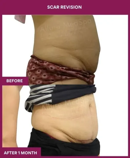 6 Scar Revision (2)_6_