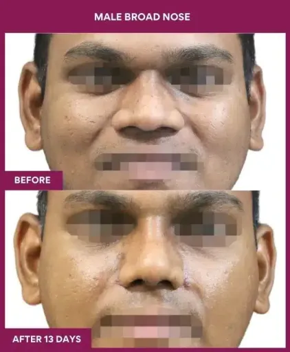 1 male broad nose in Mumbai, India