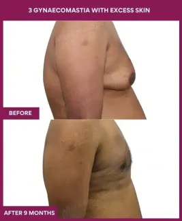 10- 3 gynaecomastia with excess skin_