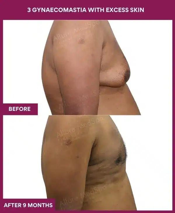 10- 3 gynaecomastia with excess skin_