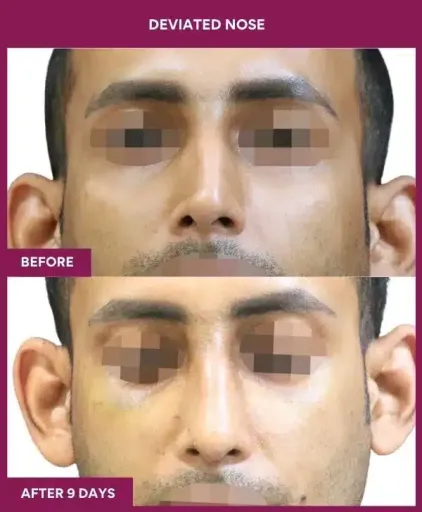 10 deviated nose_36 in Mumbai, India
